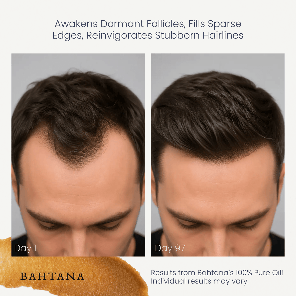 Customer before and after: fuller hairline with BAHTANA 100% pure batana oil