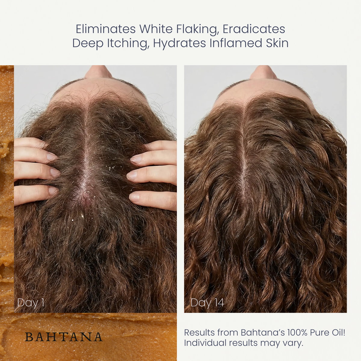 Customer before and after: hydrated scalp with less flaking, day 1 vs day 14